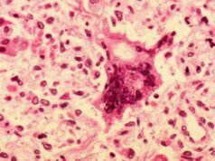Measles spreading undetected in Sydney, NSW Health warns