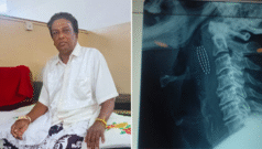 పళ్లు తోముకుంటూ బాత్రూమ్లో జారిపడ్డారు, బ్రష్ విరిగి గొంతులో ఇరుక్కుపోయింది.. ‘ఎక్స్ రే తీసినా కనిపించని’ ఆ ముక్కను ఎలా తొలగించారంటే