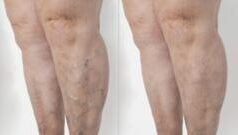 ਘੰਟਿਆਂ ਤੱਕ ਬੈਠੇ ਰਹਿੰਦੇ ਹੋ? ਜਾਣੋ ਕਿਵੇਂ ਵੈਰੀਕੋਜ਼ ਵੇਨਜ਼ ਦਾ ਖਤਰਾ ਵੱਧ ਜਾਂਦਾ ਹੈ ਅਤੇ ਇਸ ਦੇ ਕੀ ਨੁਕਸਾਨ ਹੋ ਸਕਦੇ ਹਨ