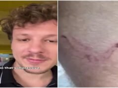 German man praises India’s healthcare after getting free treatment for dog bite