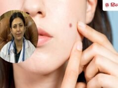 चेहरे पर तिल या मस्सा है? हमेशा के लिए हटा देगा ये 1 तेल, आयुर्वेदिक डॉक्टर ने बताया नुस्खा!
